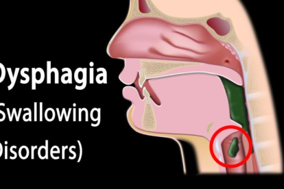 21DYS Dysphagia